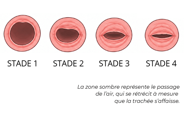 Les 4 stades du collapsus trachéal